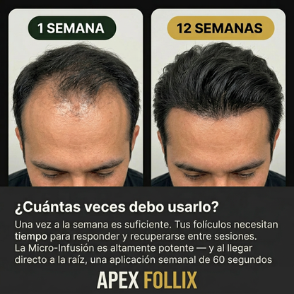 Apex Follix - Sistema de Crecimiento del Cabello y Barba