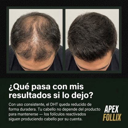 Apex Follix - Sistema de Crecimiento del Cabello y Barba